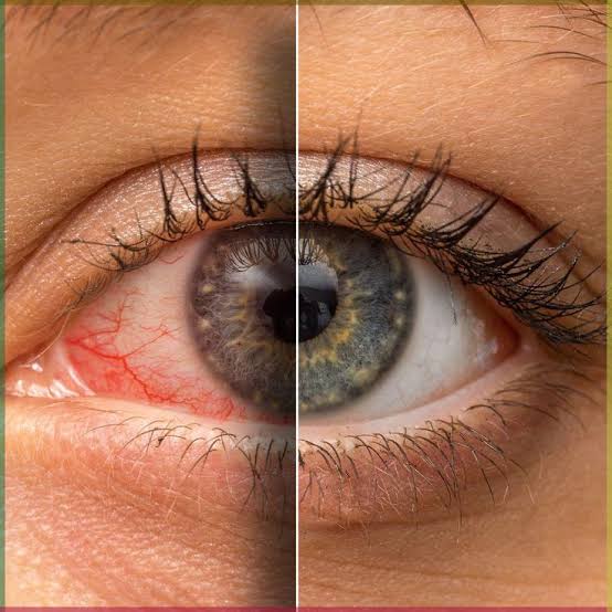 Dry Eyes: When Your Eyes Are Asking for a Break
